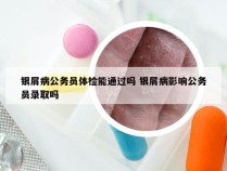 银屑病公务员体检能通过吗 银屑病影响公务员录取吗