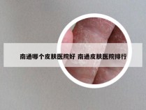 南通哪个皮肤医院好 南通皮肤医院排行