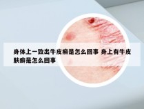 身体上一致出牛皮癣是怎么回事 身上有牛皮肤癣是怎么回事