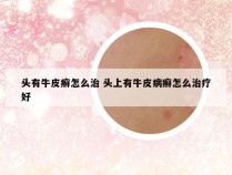 头有牛皮癣怎么治 头上有牛皮病癣怎么治疗好