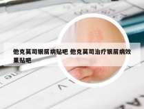 他克莫司银屑病贴吧 他克莫司治疗银屑病效果贴吧