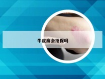 牛皮癣会拒保吗