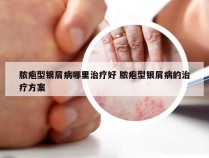 脓疱型银屑病哪里治疗好 脓疱型银屑病的治疗方案