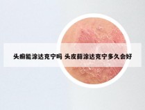 头癣能涂达克宁吗 头皮藓涂达克宁多久会好
