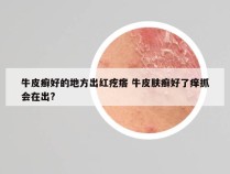 牛皮癣好的地方出红疙瘩 牛皮肤癣好了痒抓会在出?
