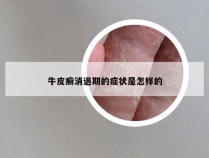 牛皮癣消退期的症状是怎样的
