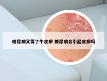 糖尿病又得了牛皮癣 糖尿病会引起皮癣吗
