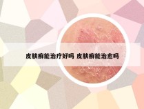 皮肤癣能治疗好吗 皮肤癣能治愈吗