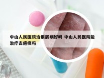 中山人民医院治银屑病好吗 中山人民医院能治疗去疤痕吗