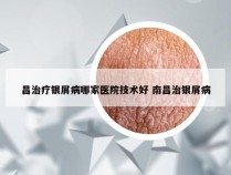 昌治疗银屑病哪家医院技术好 南昌治银屑病