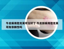 牛皮癣用他克莫司治好了 牛皮肤癣用他克莫司有依赖性吗