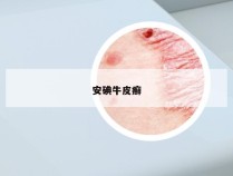 安碘牛皮癣