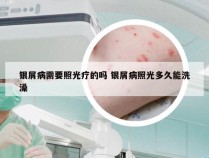 银屑病需要照光疗的吗 银屑病照光多久能洗澡