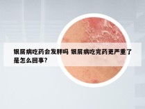 银屑病吃药会发胖吗 银屑病吃完药更严重了是怎么回事?