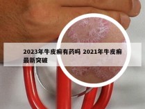 2023年牛皮癣有药吗 2021年牛皮癣最新突破