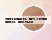 过敏性紫癜和银屑病是一样的吗 过敏性紫癜和银屑病是一样的吗怎么治疗