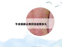 牛皮癣静止期到消退期多久