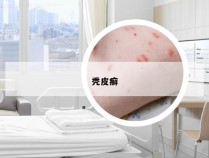秃皮癣