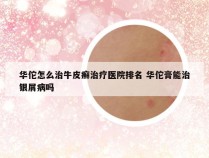 华佗怎么治牛皮癣治疗医院排名 华佗膏能治银屑病吗