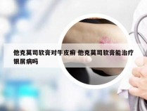 他克莫司软膏对牛皮癣 他克莫司软膏能治疗银屑病吗