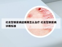 红皮型银屑病进展期怎么治疗 红皮型银屑病诊断标准