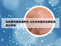 协和医院银屑病照光 北京协和医院治银屑病用住院吗