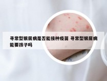 寻常型银屑病是否能接种疫苗 寻常型银屑病能要孩子吗