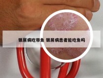 银屑病吃带鱼 银屑病患者能吃鱼吗