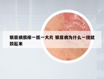 银屑病很痒一抓一大片 银屑病为什么一挠就鼓起来