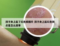 孩子身上起了红色癣图片 孩子身上起红色斑点是怎么回事