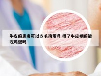 牛皮癣患者可以吃毛鸡蛋吗 得了牛皮病癣能吃鸡蛋吗