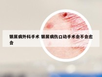银屑病外科手术 银屑病伤口动手术会不会愈合