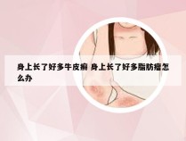 身上长了好多牛皮癣 身上长了好多脂肪瘤怎么办