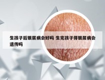 生孩子后银屑病会好吗 生完孩子得银屑病会遗传吗