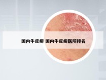 国内牛皮癣 国内牛皮癣医院排名