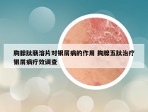 胸腺肽肠溶片对银屑病的作用 胸腺五肽治疗银屑病疗效调查