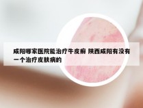 咸阳哪家医院能治疗牛皮癣 陕西咸阳有没有一个治疗皮肤病的