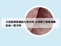 小孩患银屑病的几率大吗 小孩得了银屑病要影响一辈子吗