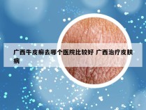 广西牛皮癣去哪个医院比较好 广西治疗皮肤病