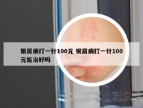 银屑病打一针100元 银屑病打一针100元能治好吗