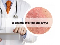 银屑病颗粒大洋 银屑灵颗粒大洋