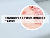 河南省银宵病专治最好的医院 河南银屑病治疗最好医院