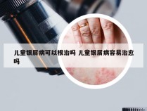 儿童银屑病可以根治吗 儿童银屑病容易治愈吗