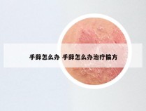 手藓怎么办 手藓怎么办治疗偏方