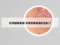 肛周围银屑病 寻常型银屑病长在肛门
