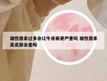 雄性激素过多会让牛皮癣更严重吗 雄性激素高皮肤会差吗