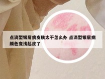 点滴型银屑病皮肤太干怎么办 点滴型银屑病颜色变浅起皮了