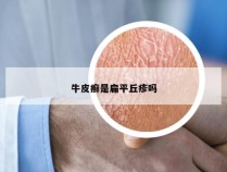 牛皮癣是扁平丘疹吗