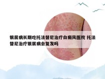 银屑病长期吃托法替尼治疗白癜风医院 托法替尼治疗银屑病会复发吗