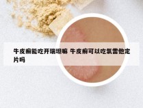 牛皮癣能吃开瑞坦嘛 牛皮癣可以吃氯雷他定片吗